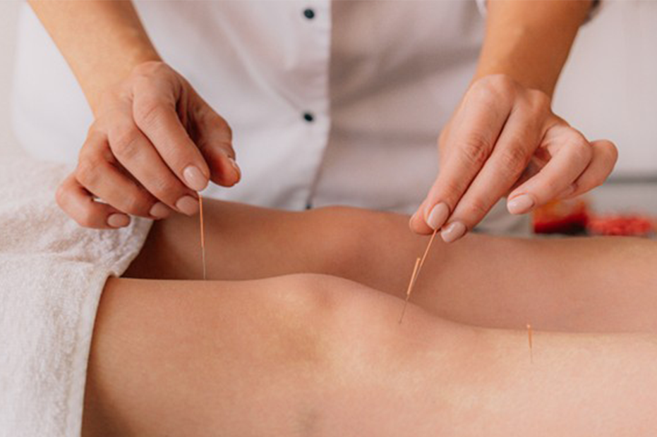 Akupunktur